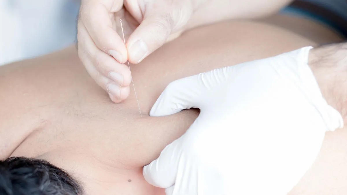 Dry Needling: feine Nadel wird in einen Triggerpunkt an der Schulter gesetzt